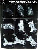 Спиральная компьютерная томография стопы - плосковальгусная деформация