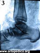 Рентгенограмма в боковой проекции после операции подтаранного артродеза