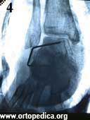 Рентгенограмма после операции подтаранного артродеза