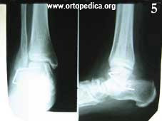 Рентгенограмма через 2 месяца после операции подтаранного артродеза