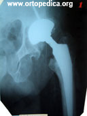 Перелом бедренной кости ниже уровня эндопротеза