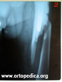 Перелом бедренной кости ниже уровня эндопротеза