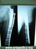 Вид после остеосинтеза пластинкой и шурупами