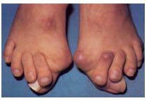 Вальгусная деформация