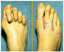 Вальгусная деформация